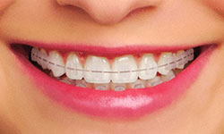 Types of Braces - Pitt Meadows Orthodontics